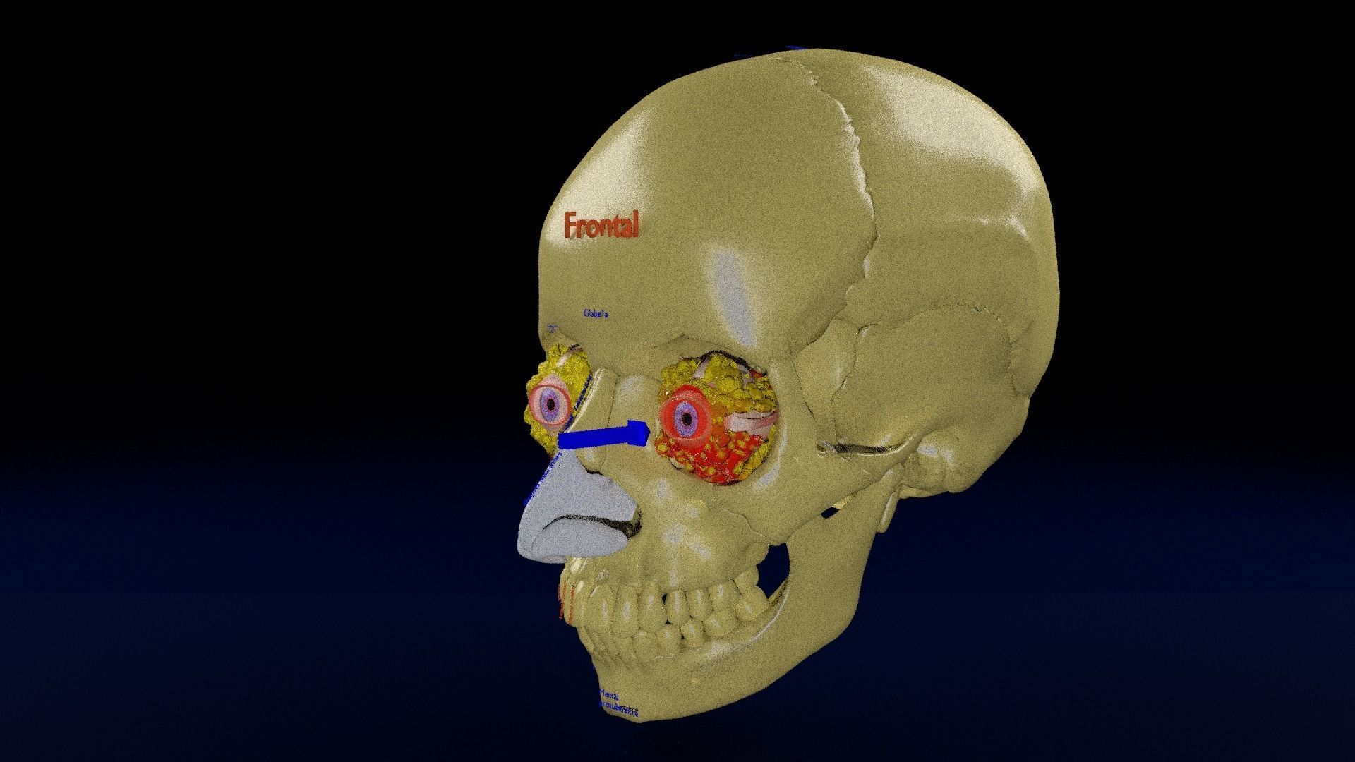 Blowout eye injury and fracture 3D model_36