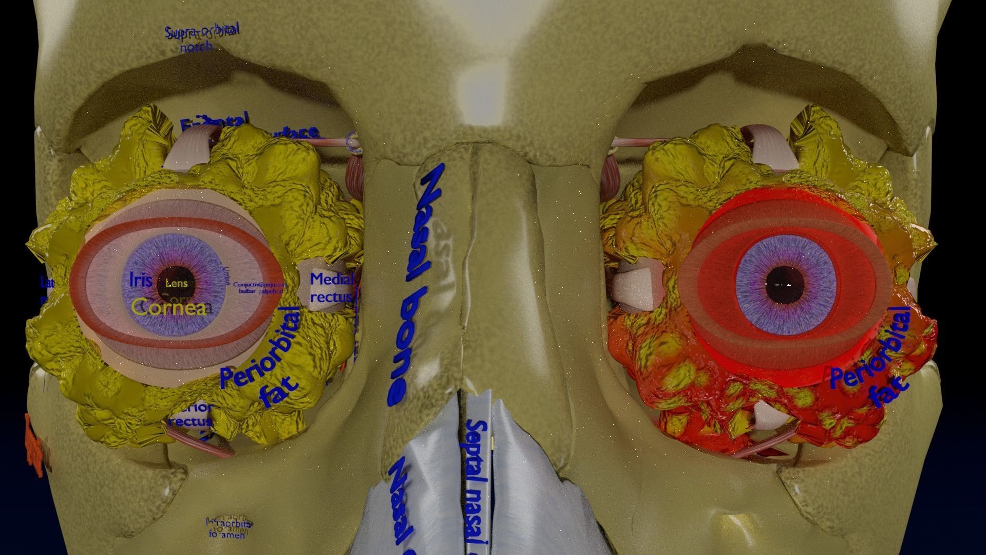 Blowout eye injury and fracture 3D model_41