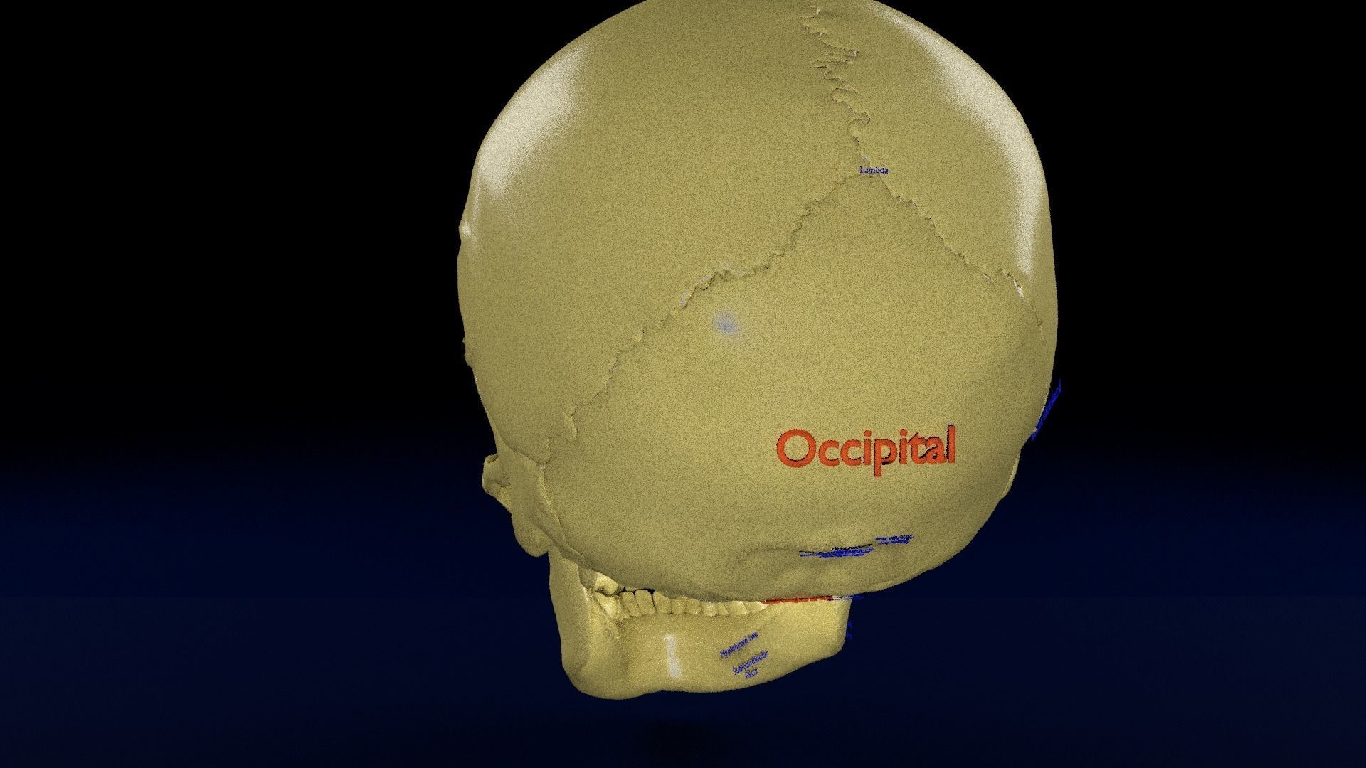 Blowout eye injury and fracture 3D model_28
