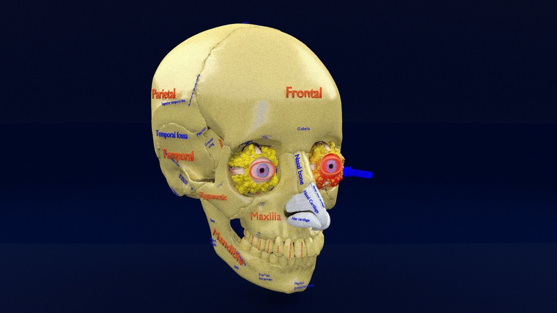 Blowout eye injury and fracture 3D model_17