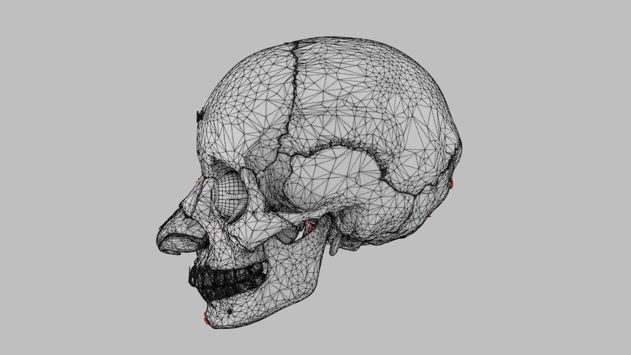 Blowout eye injury and fracture 3D model_50