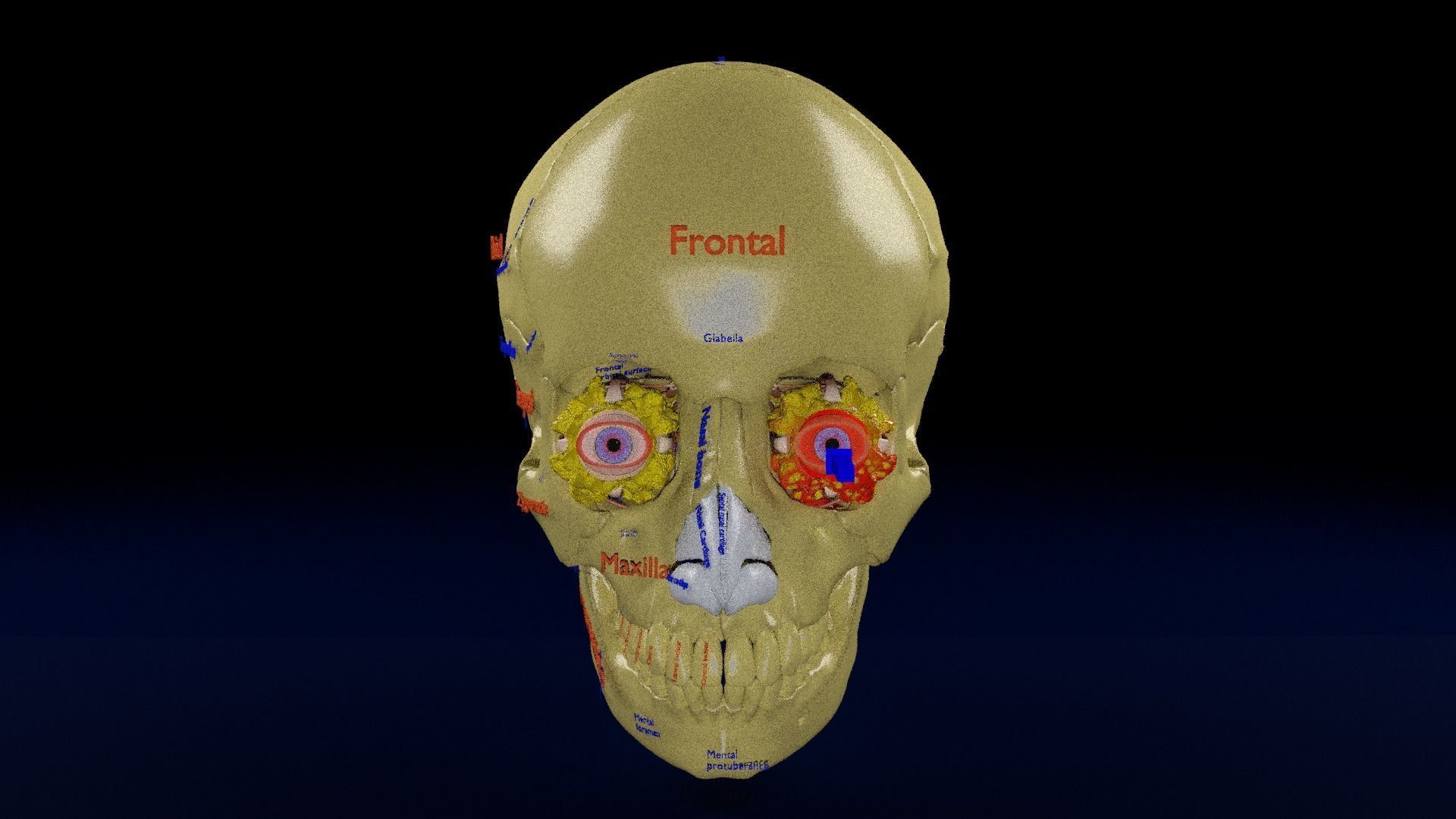 Blowout eye injury and fracture 3D model_39