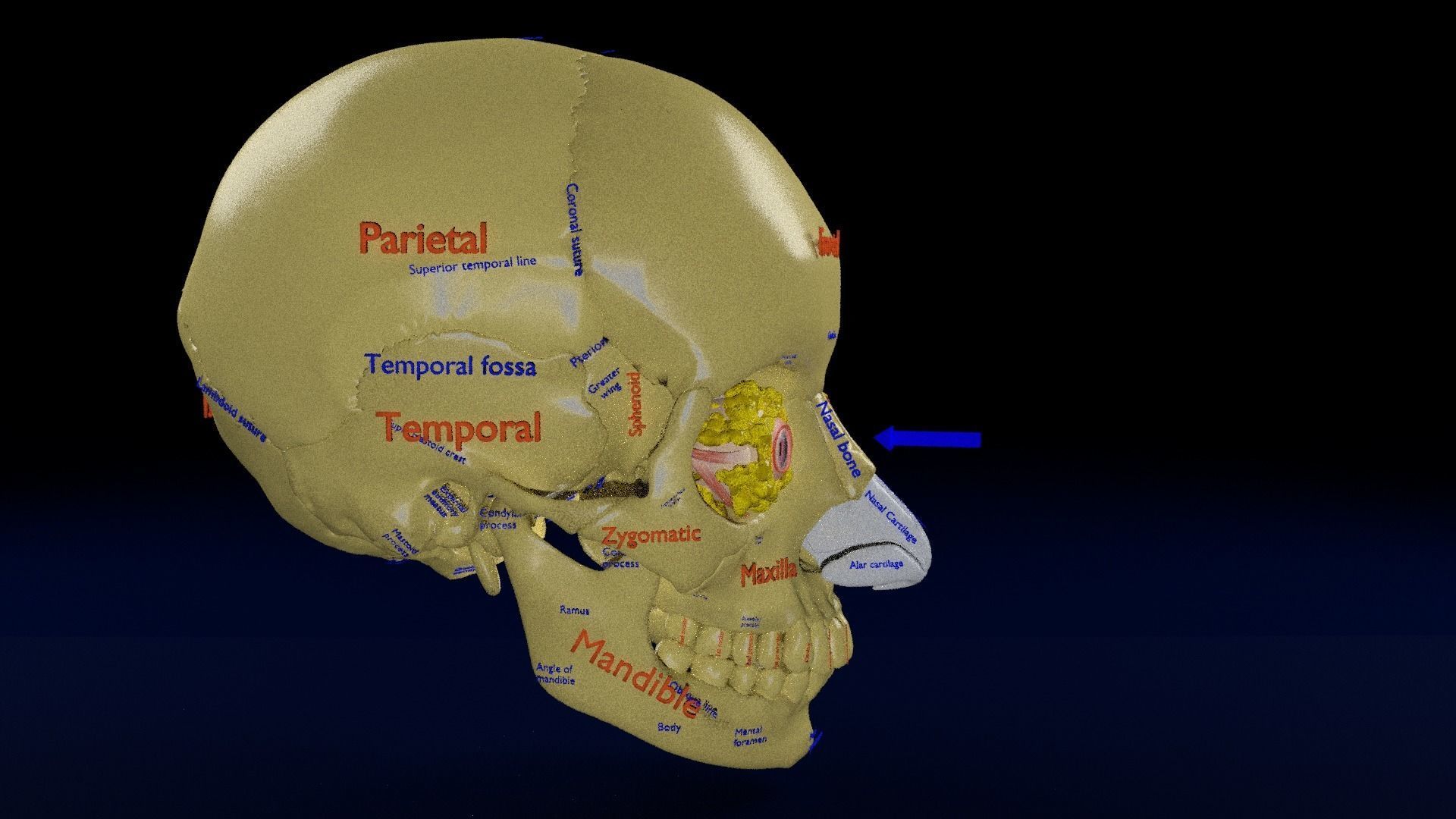 Blowout eye injury and fracture 3D model_20