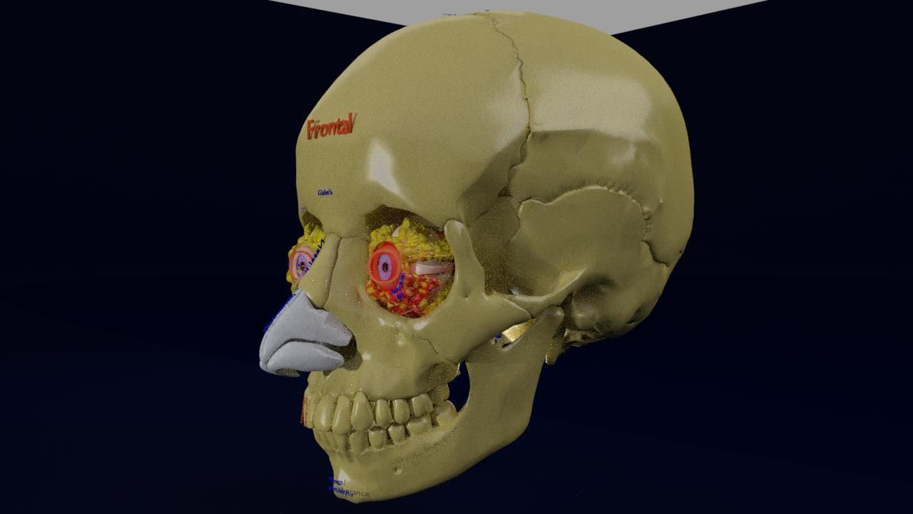Blowout eye injury and fracture 3D model_11