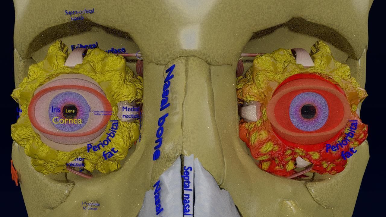 Blowout eye injury and fracture 3D model_6