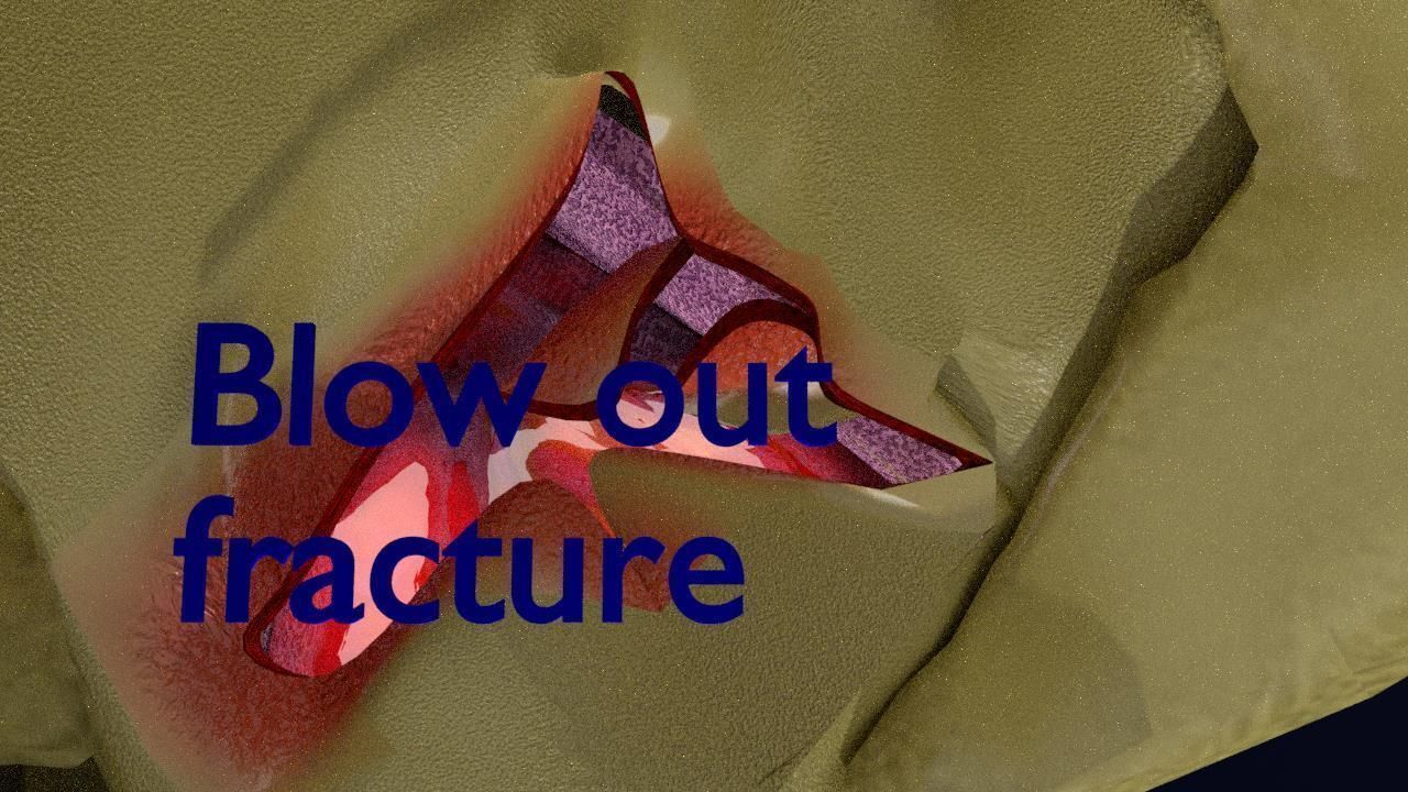 Blowout eye injury and fracture 3D model_10