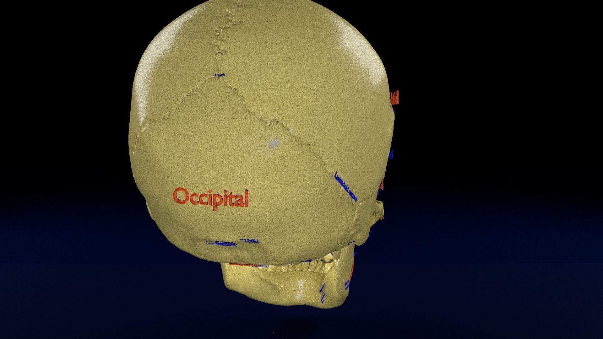 Blowout eye injury and fracture 3D model_26