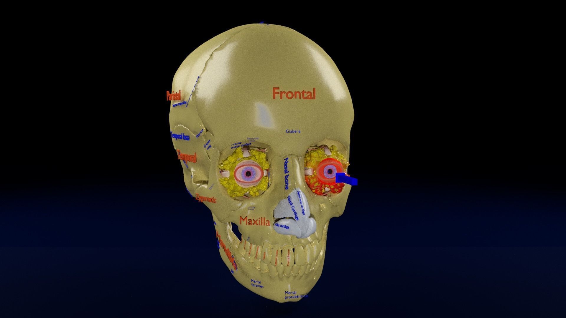 Blowout eye injury and fracture 3D model_16