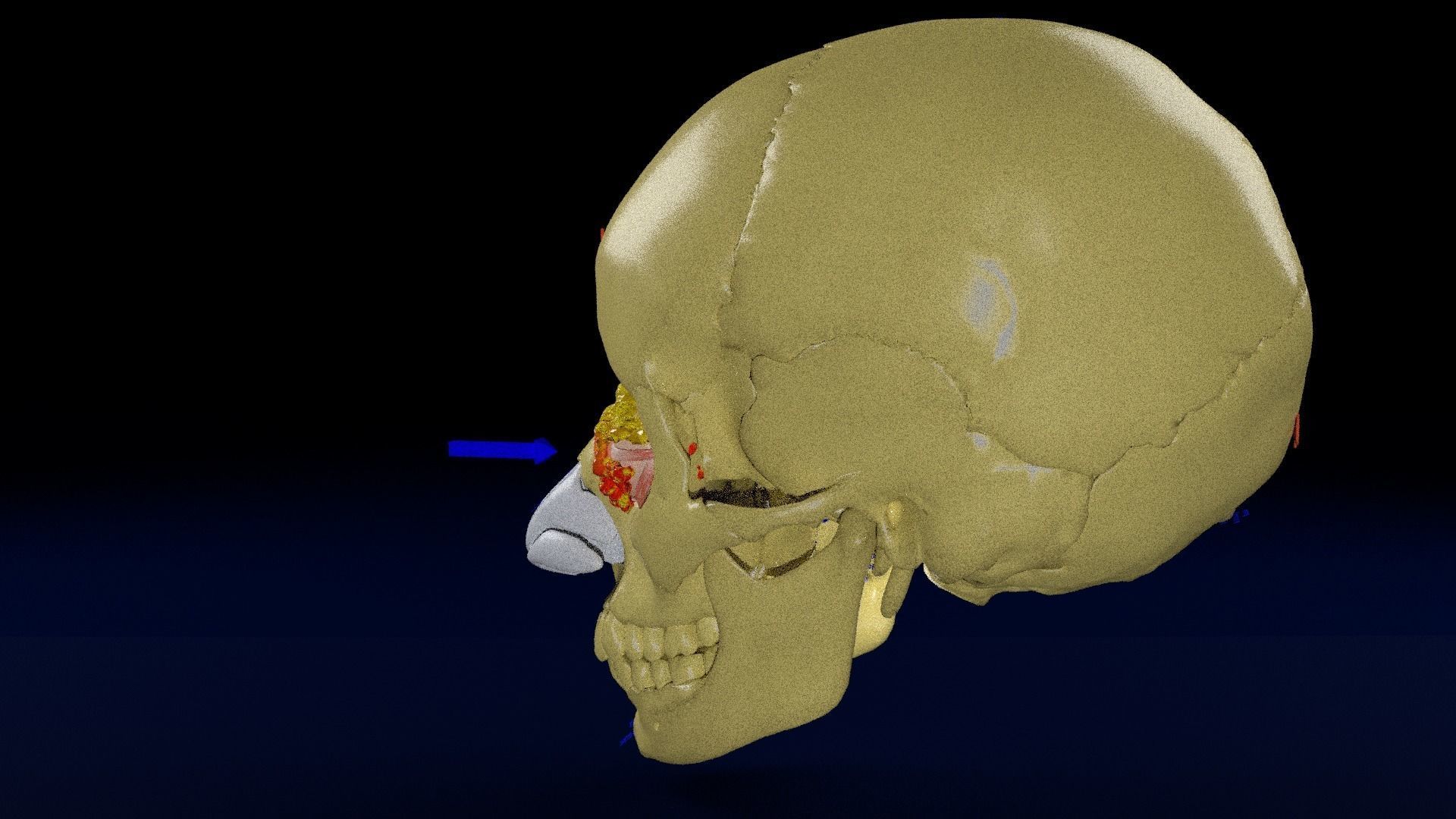 Blowout eye injury and fracture 3D model_32