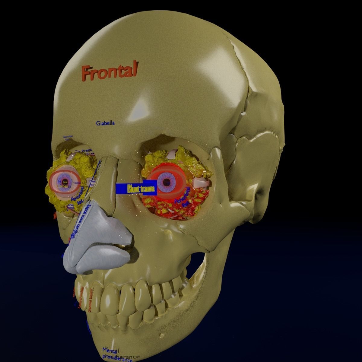 Blowout eye injury and fracture 3D model_46