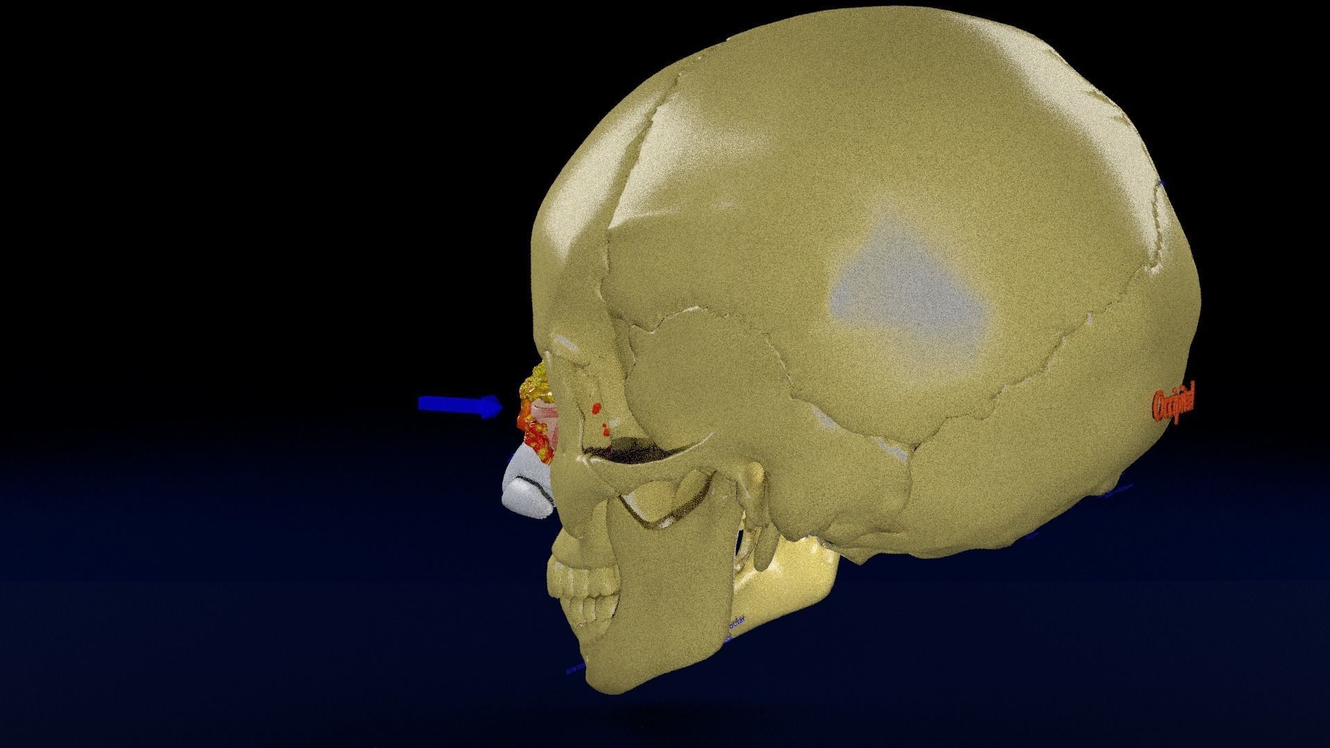 Blowout eye injury and fracture 3D model_31