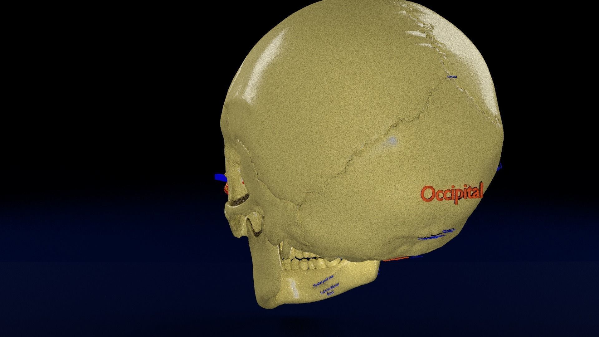 Blowout eye injury and fracture 3D model_29