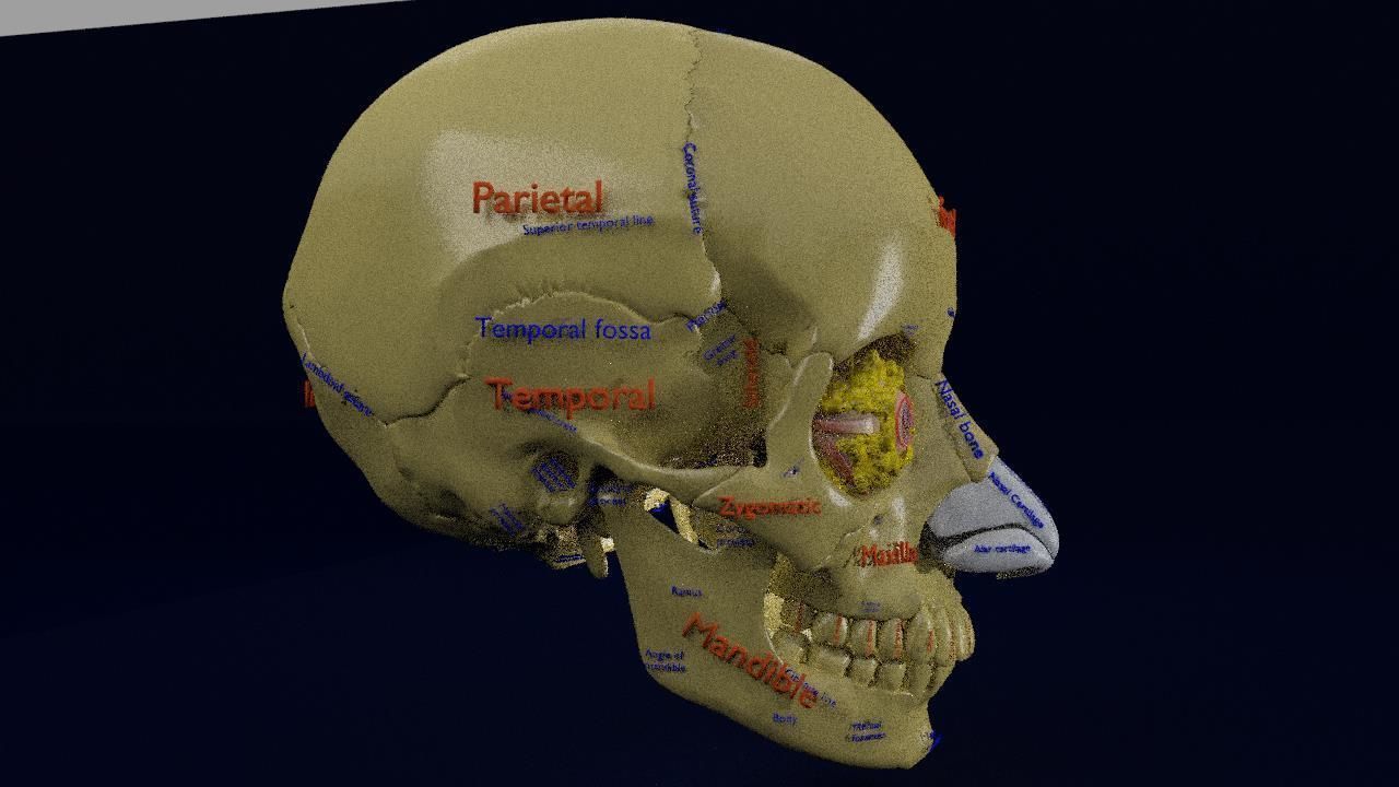 Blowout eye injury and fracture 3D model_13