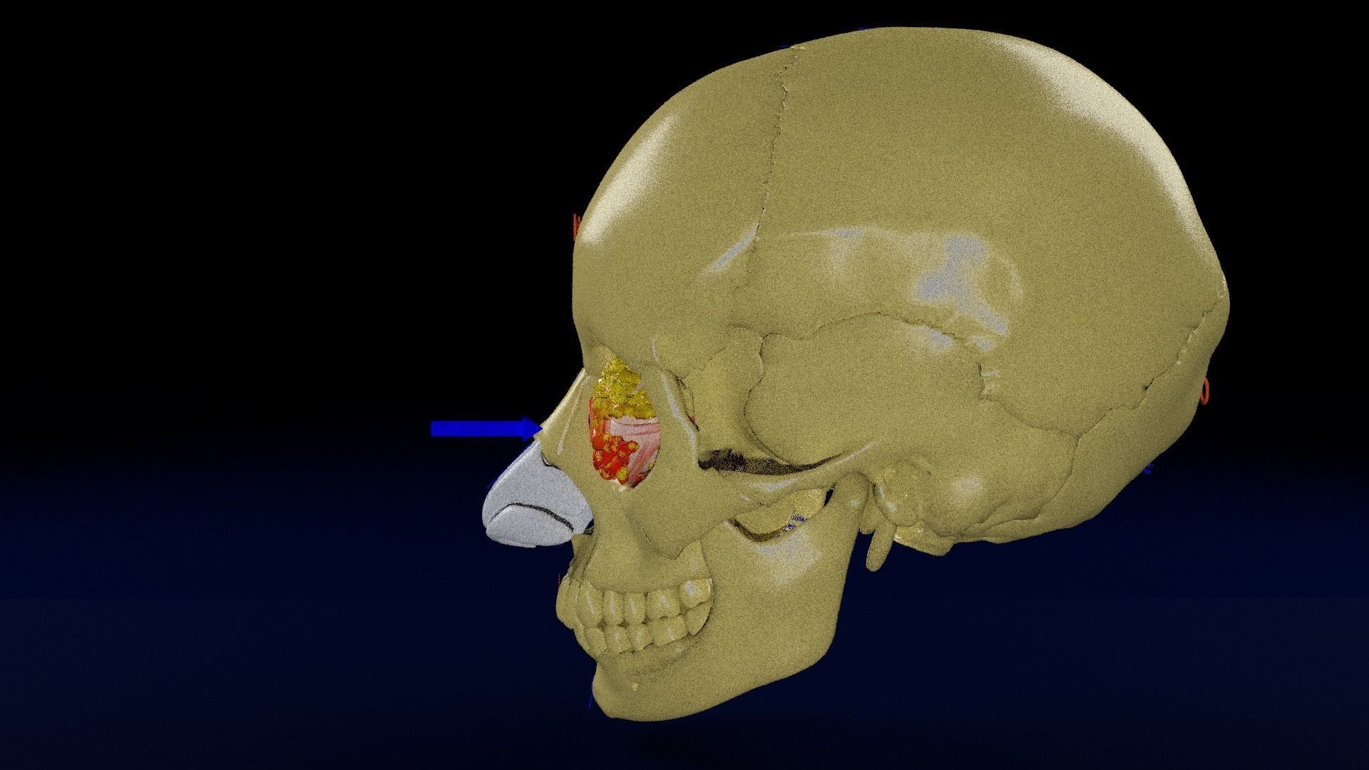 Blowout eye injury and fracture 3D model_33