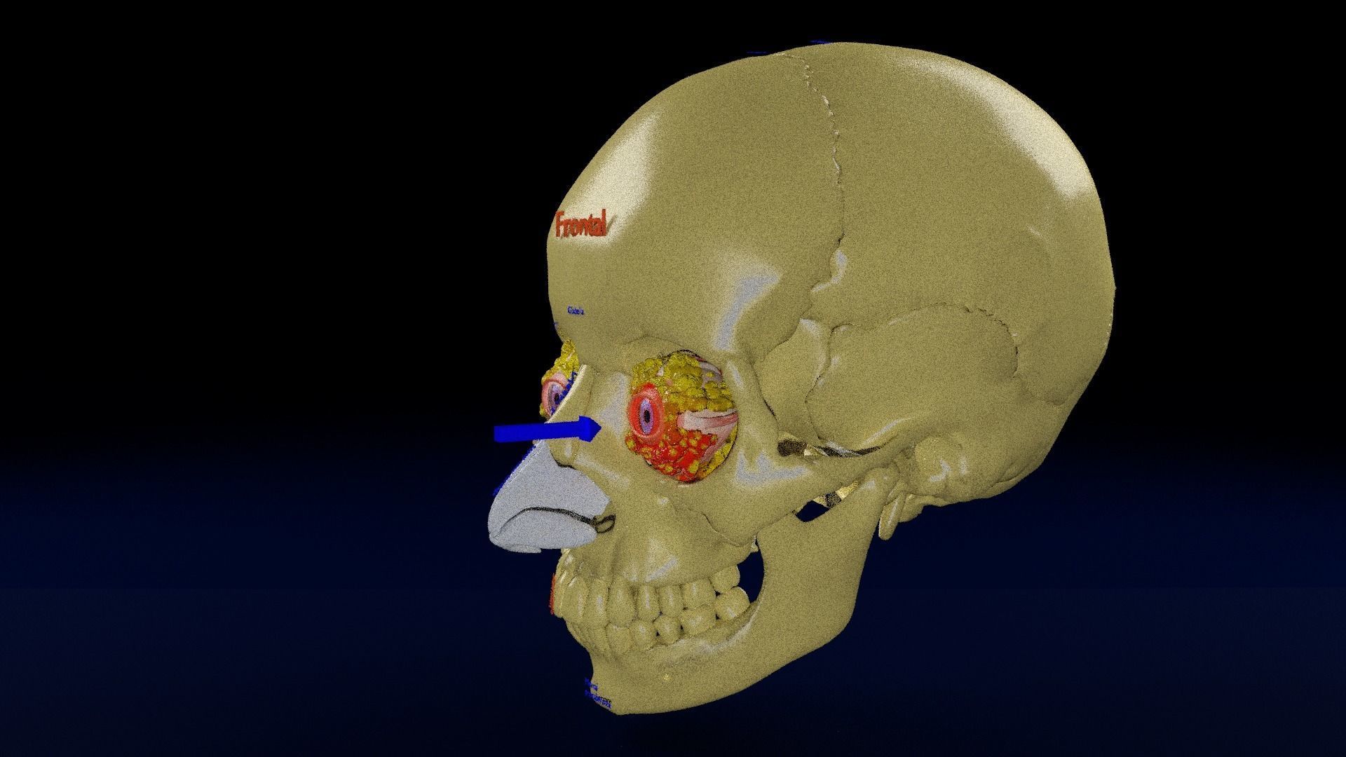 Blowout eye injury and fracture 3D model_35