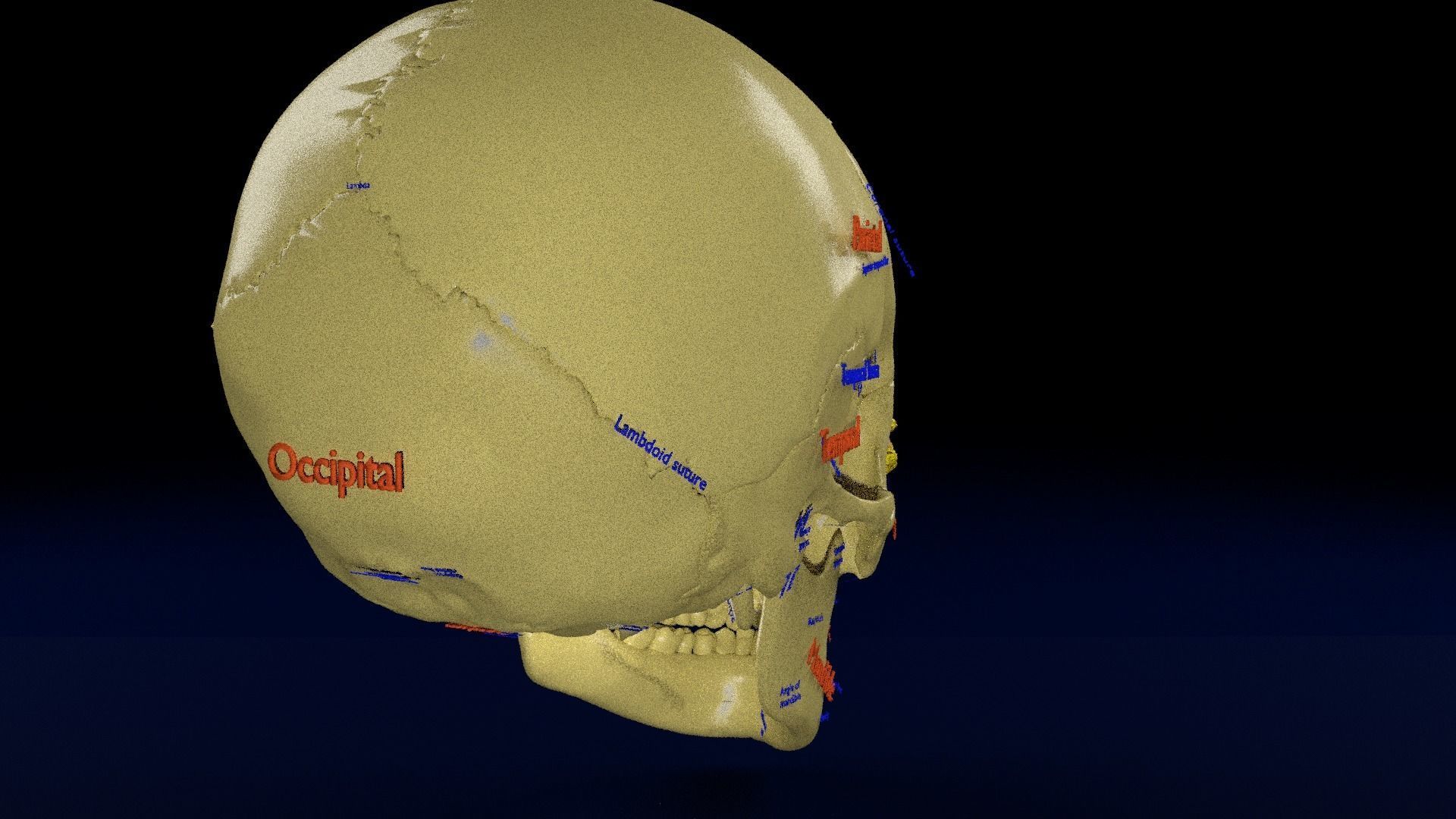 Blowout eye injury and fracture 3D model_25
