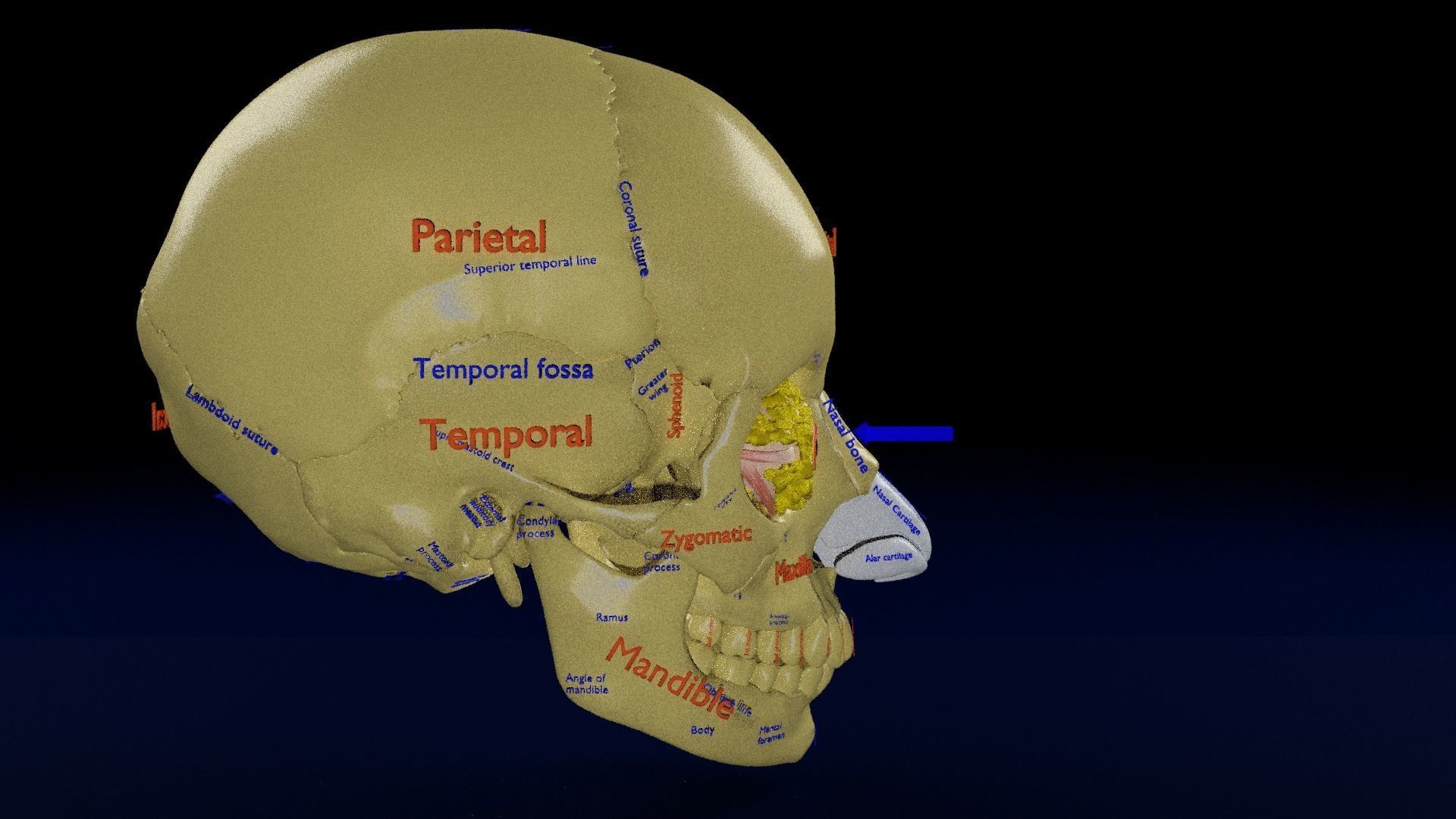 Blowout eye injury and fracture 3D model_21