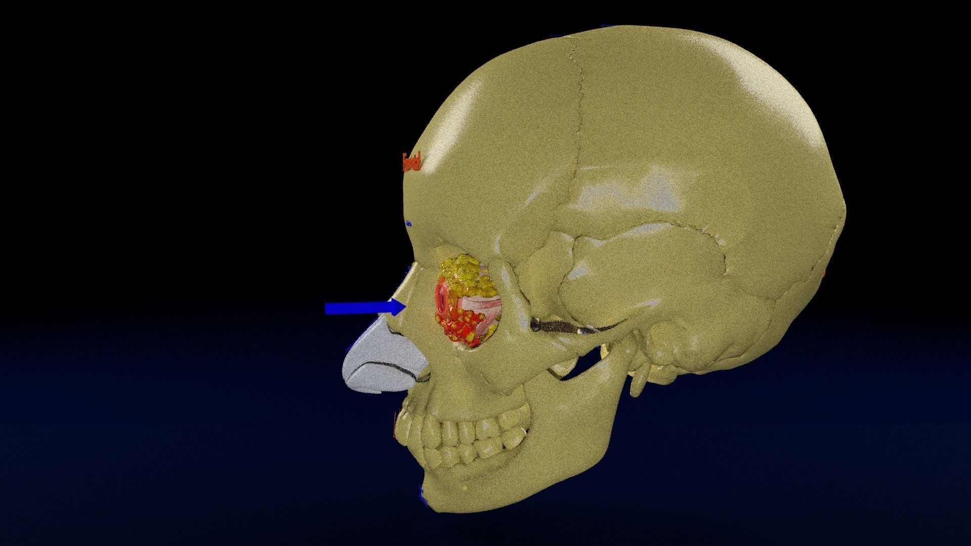 Blowout eye injury and fracture 3D model_34