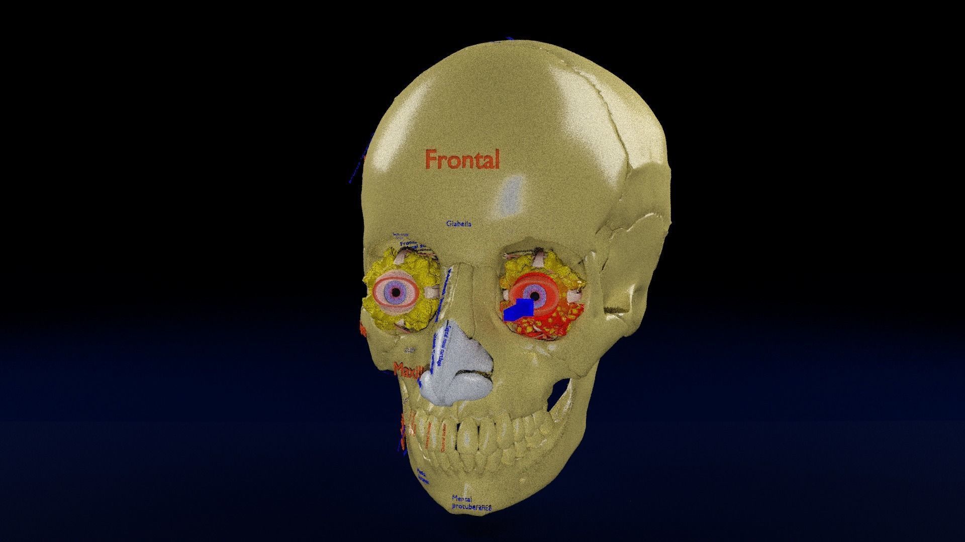 Blowout eye injury and fracture 3D model_38