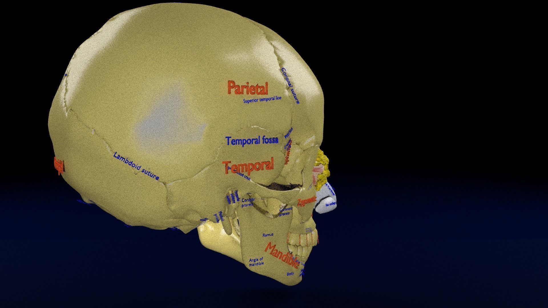 Blowout eye injury and fracture 3D model_23