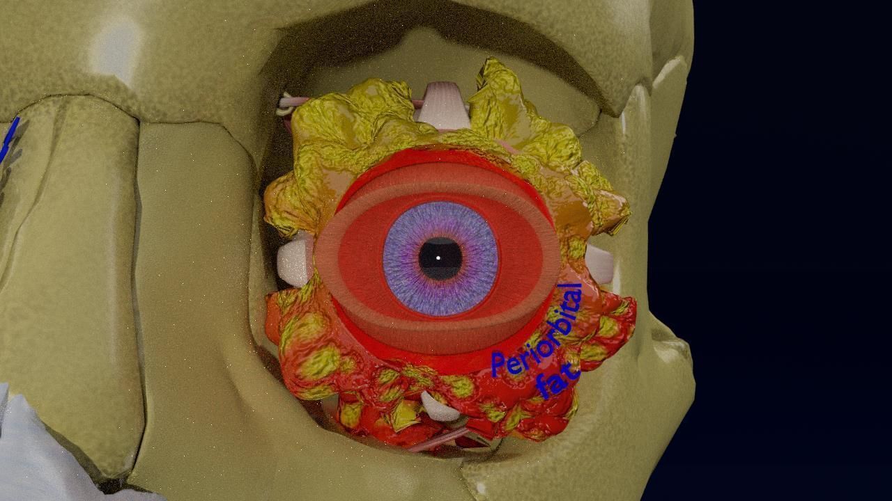 Blowout eye injury and fracture 3D model_5