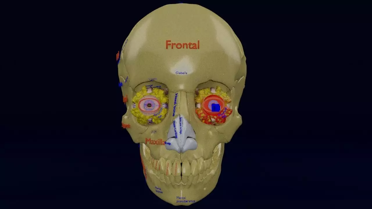 Blowout eye injury and fracture 3D model_0