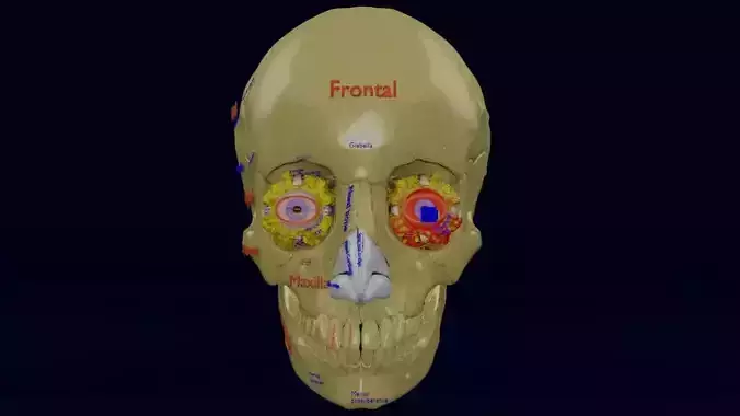 Blowout eye injury and fracture 3D model