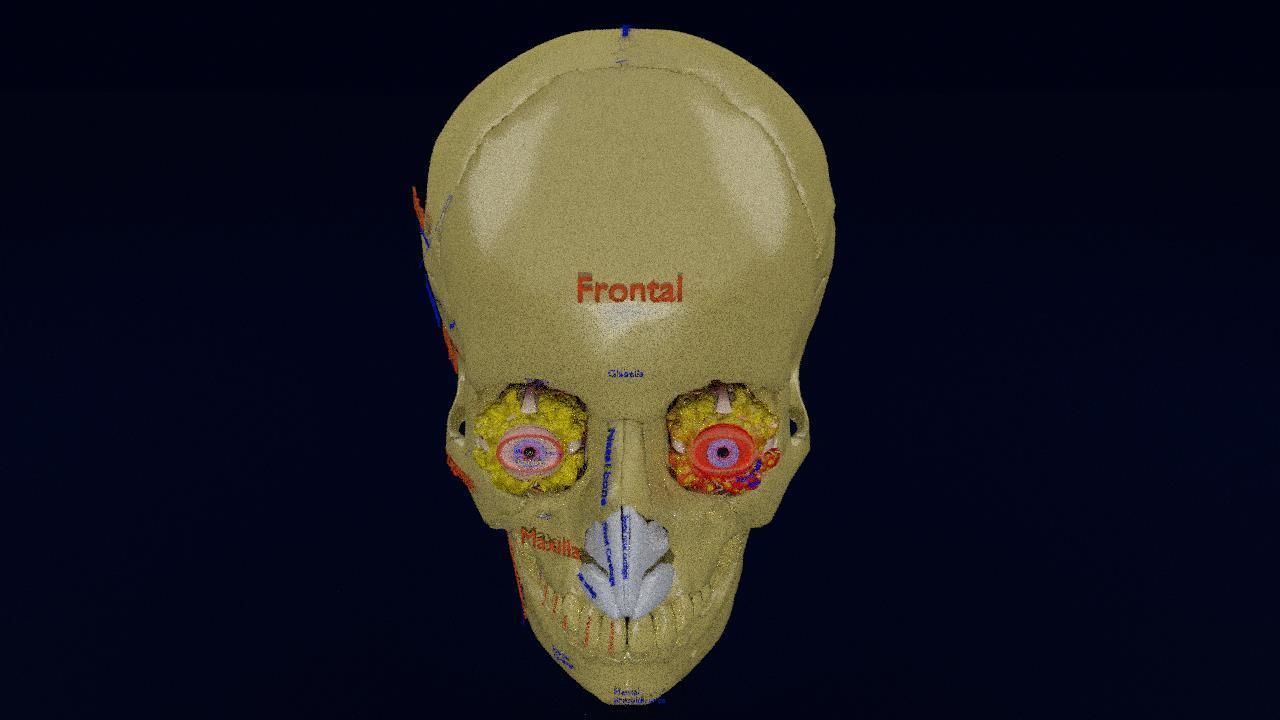 Blowout eye injury and fracture 3D model_14