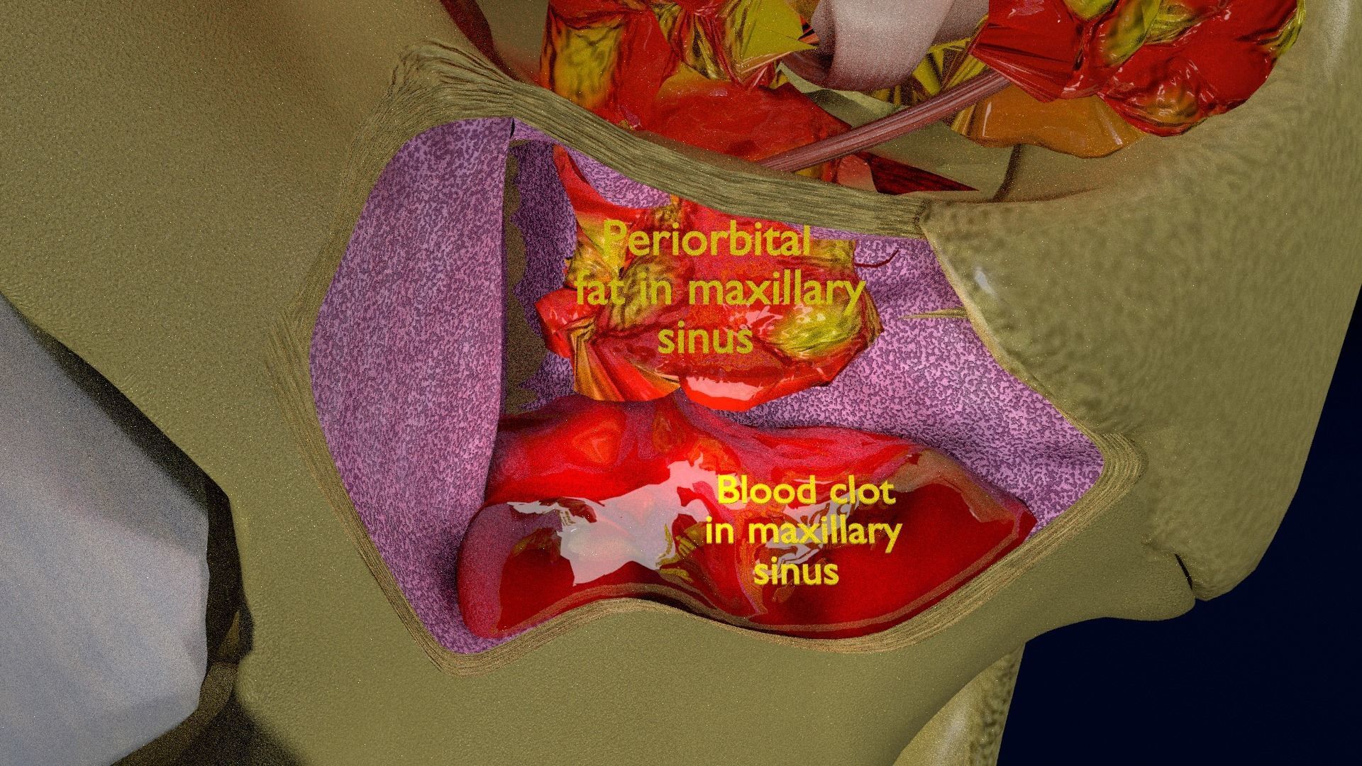 Blowout eye injury and fracture 3D model_42
