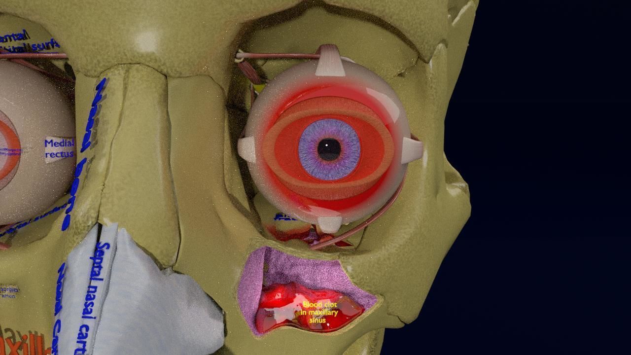 Blowout eye injury and fracture 3D model_8