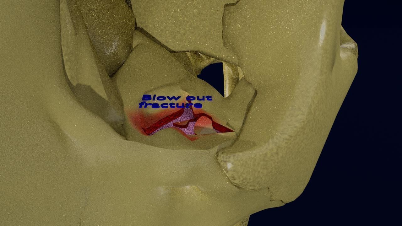 Blowout eye injury and fracture 3D model_9