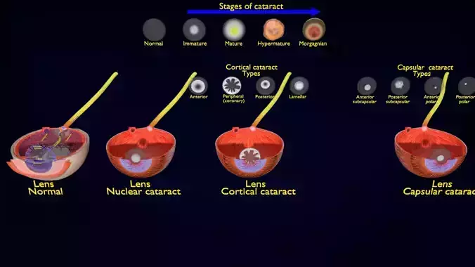 cataract eye lens types detailed animated