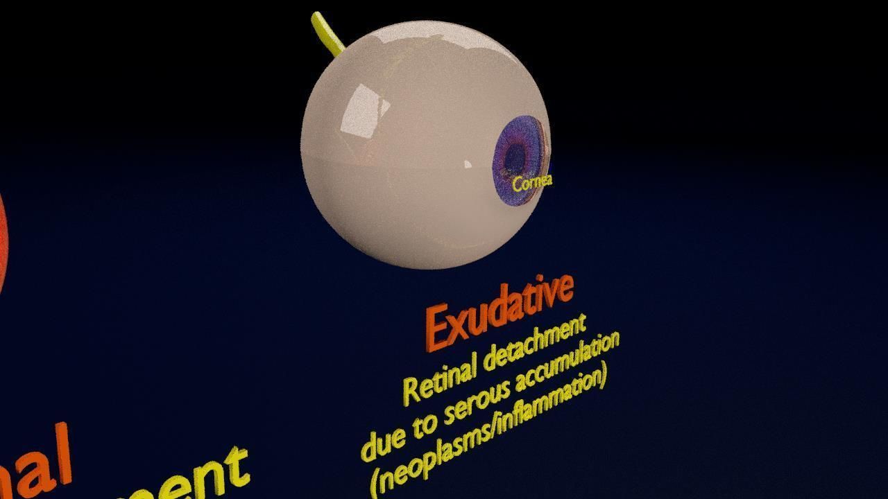 Retinal detachment types eye 3D model_13