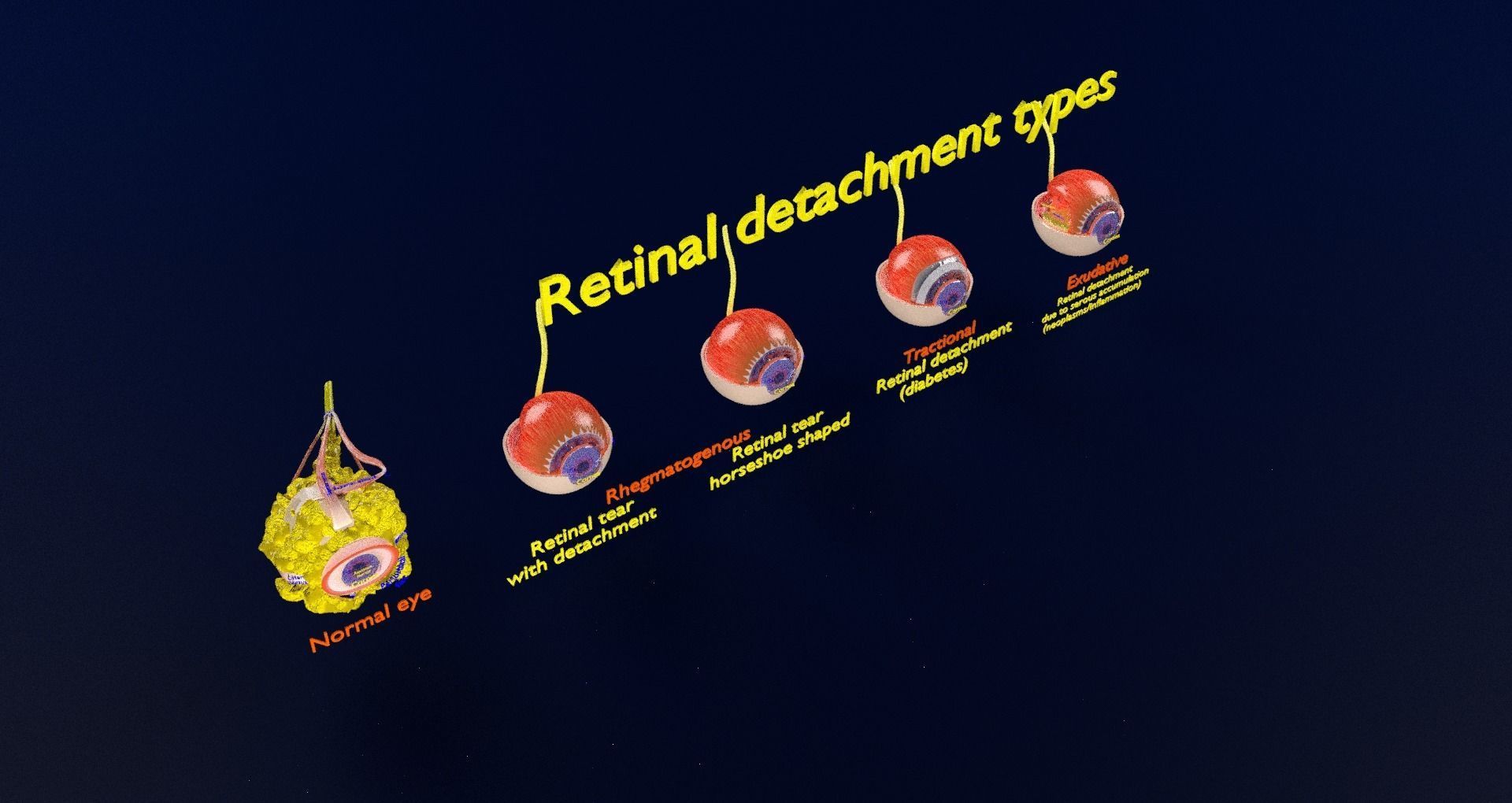 Retinal detachment types eye 3D model_38