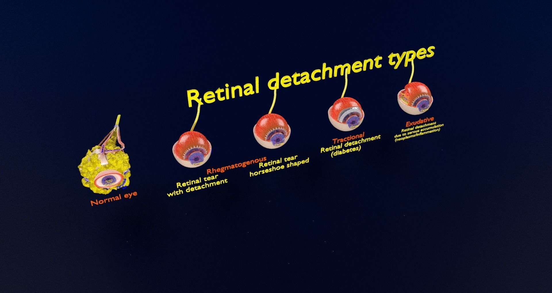 Retinal detachment types eye 3D model_37