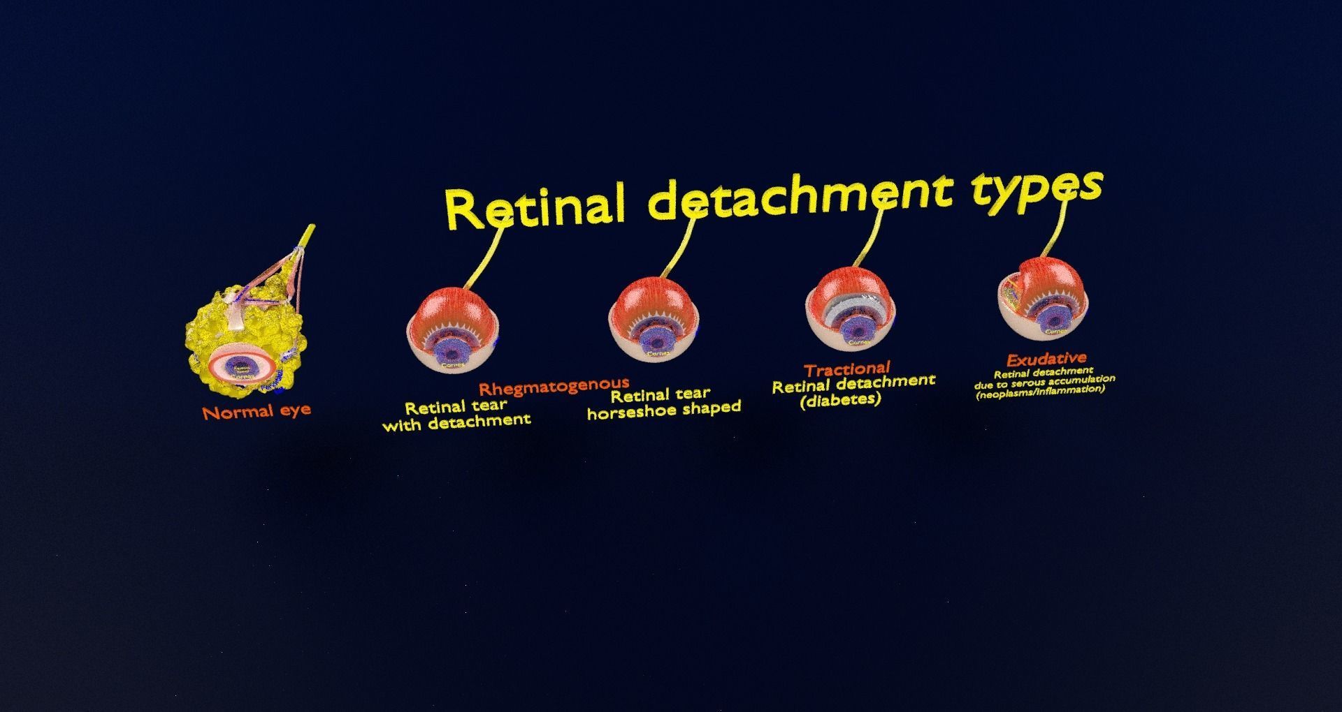 Retinal detachment types eye 3D model_32