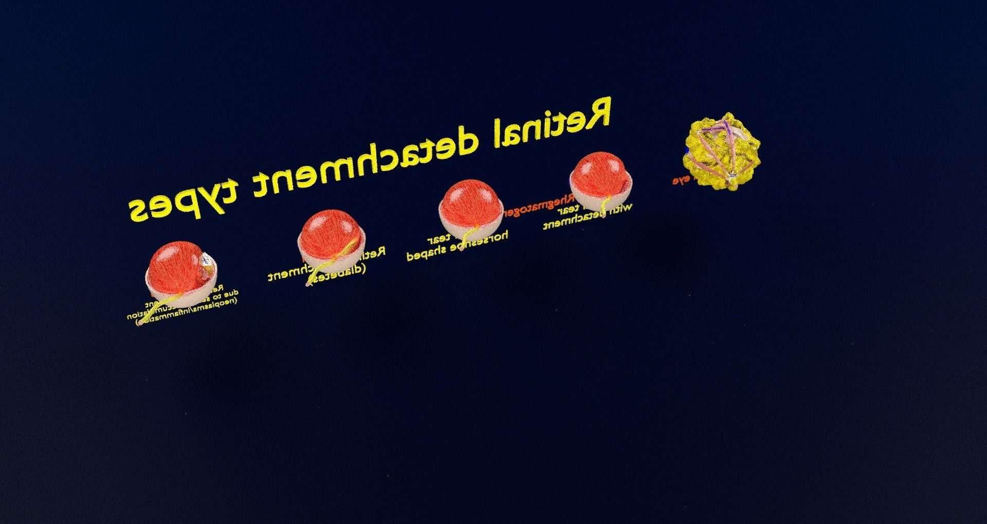 Retinal detachment types eye 3D model_70