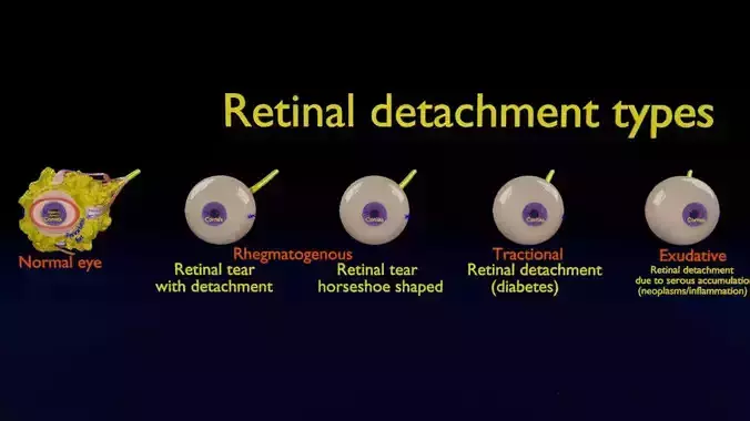 Retinal detachment types eye