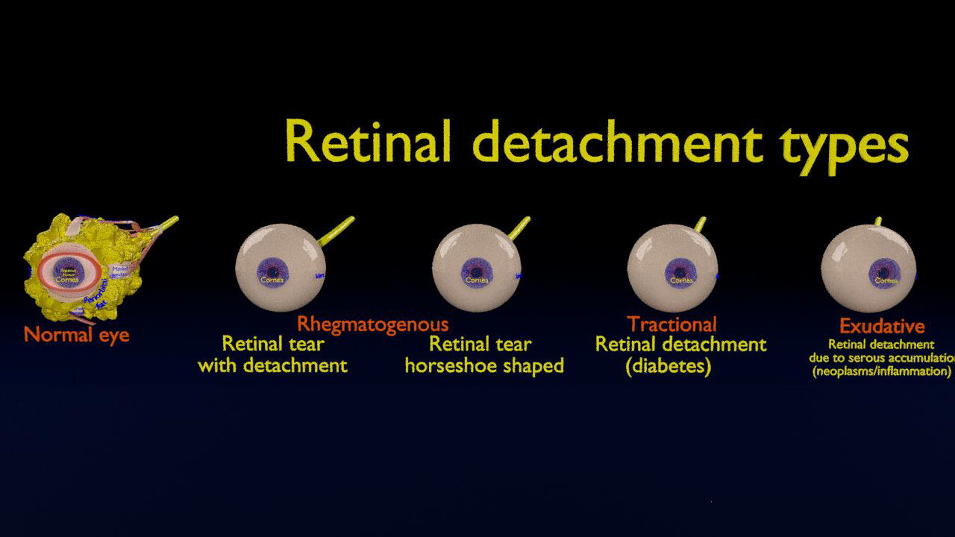 Retinal detachment types eye 3D model | CGTrader