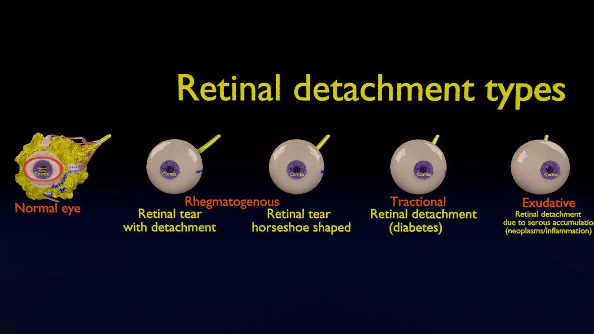 Retinal detachment types eye 3D model_0