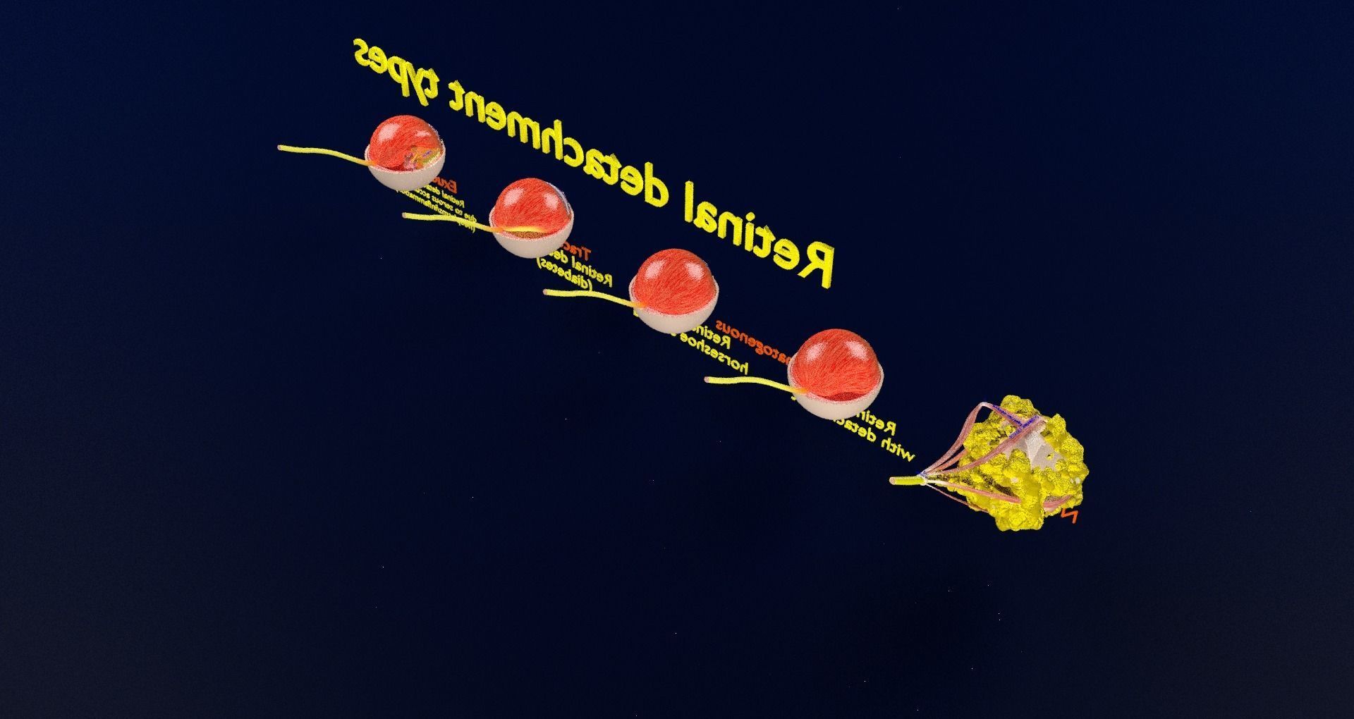Retinal detachment types eye 3D model_57