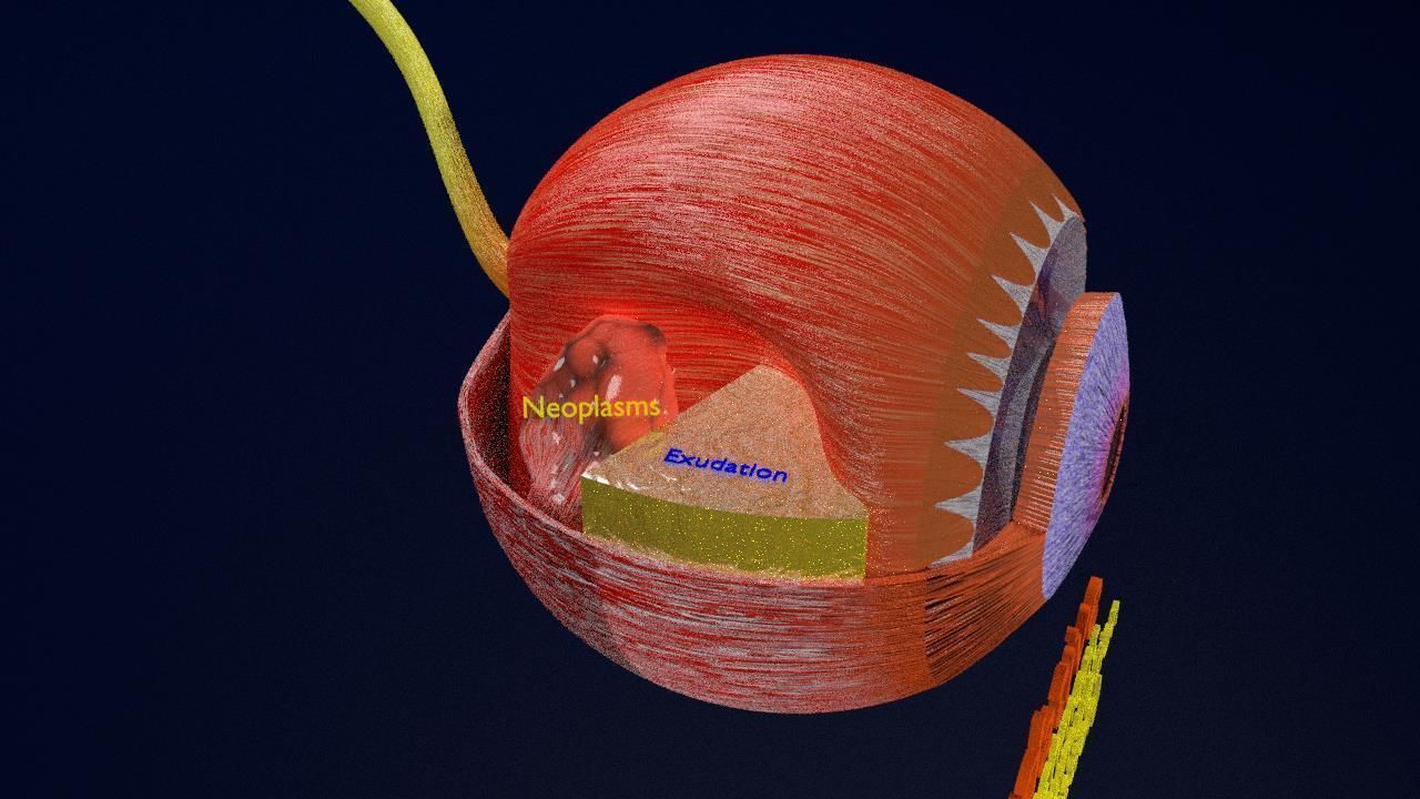Retinal detachment types eye 3D model | CGTrader