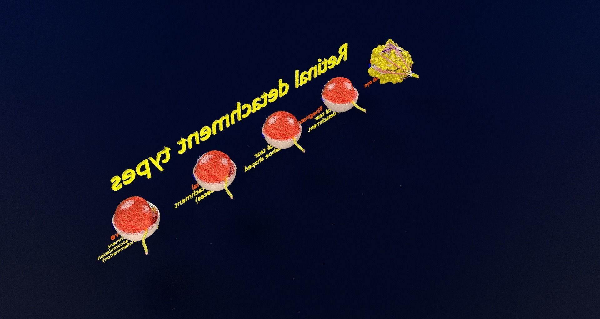 Retinal detachment types eye 3D model_77