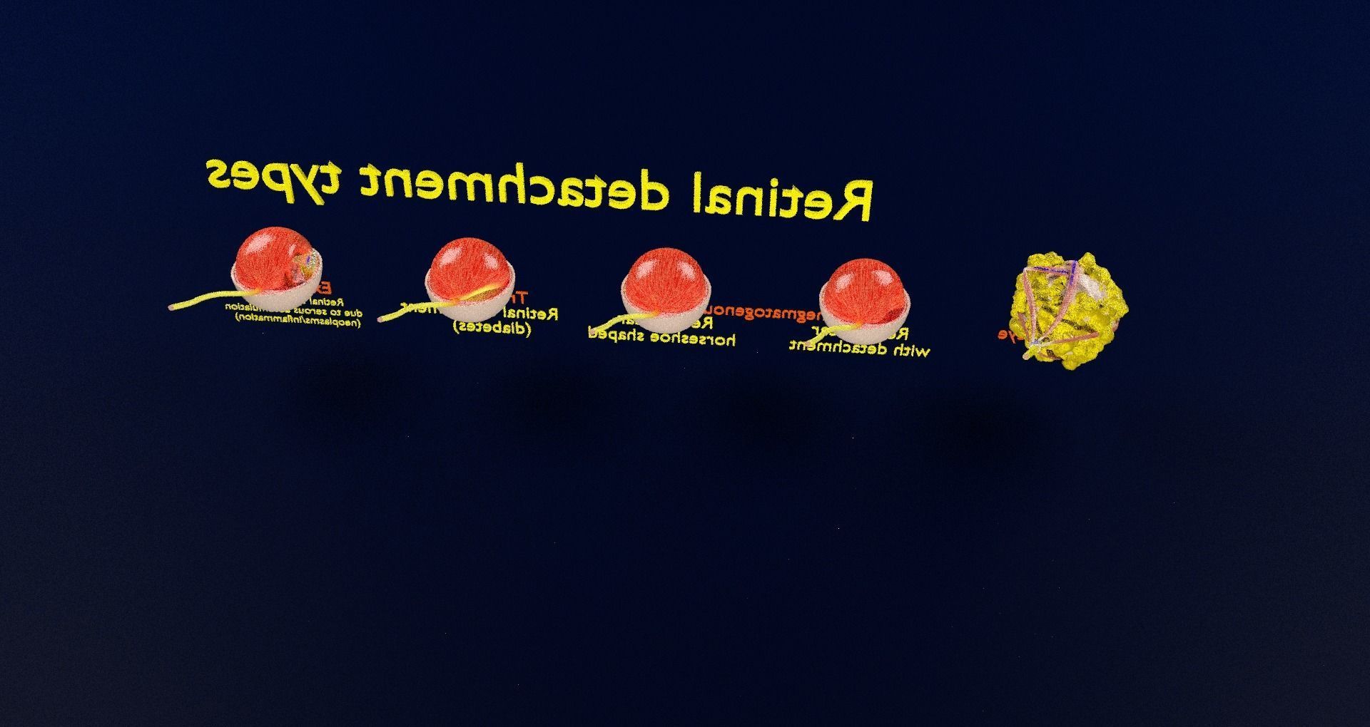 Retinal detachment types eye 3D model_65