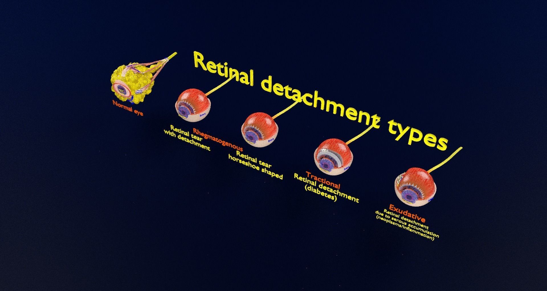Retinal detachment types eye 3D model_100