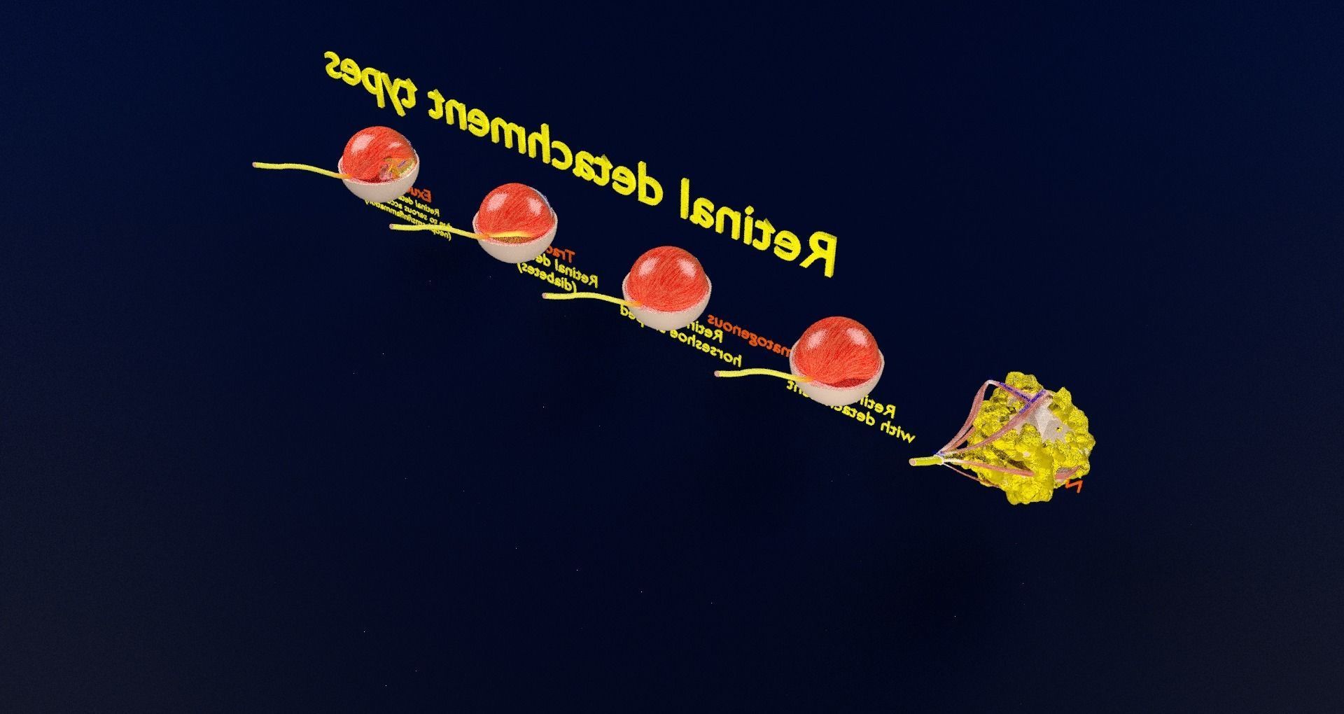 Retinal detachment types eye 3D model_59