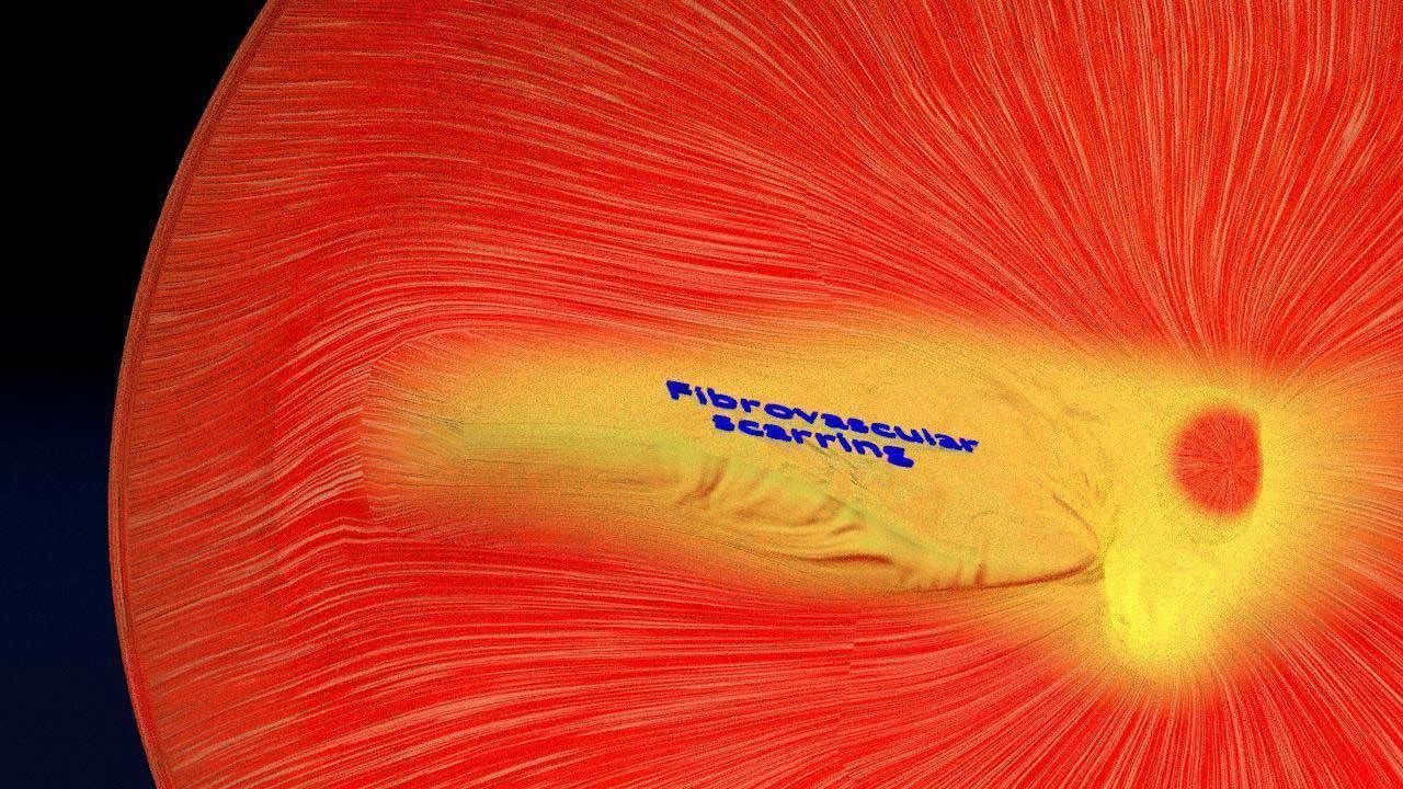 Retinal detachment types eye 3D model | CGTrader
