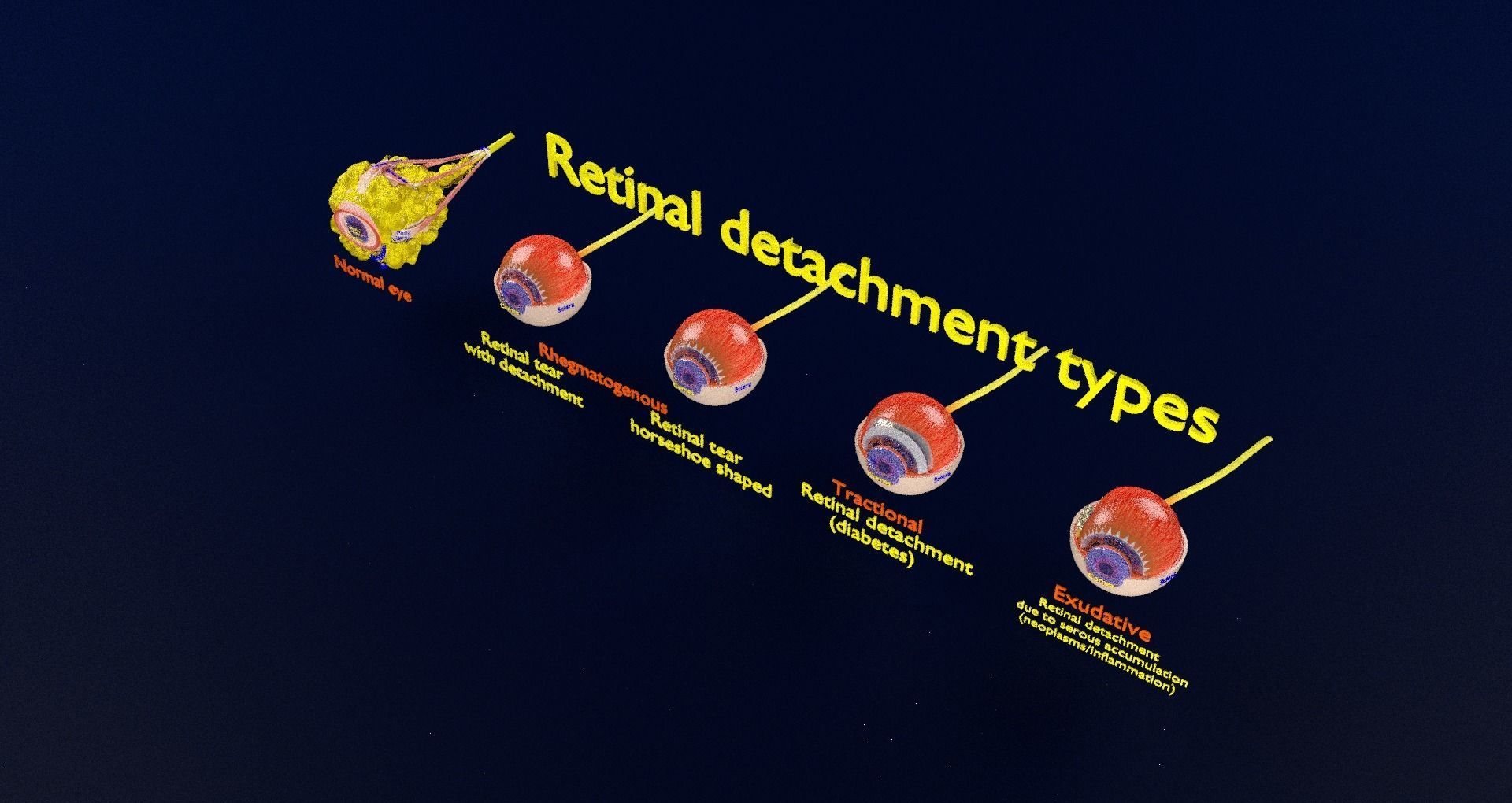 Retinal detachment types eye 3D model_29
