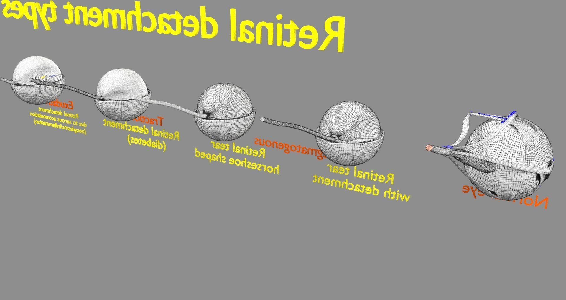 Retinal detachment types eye 3D model_21