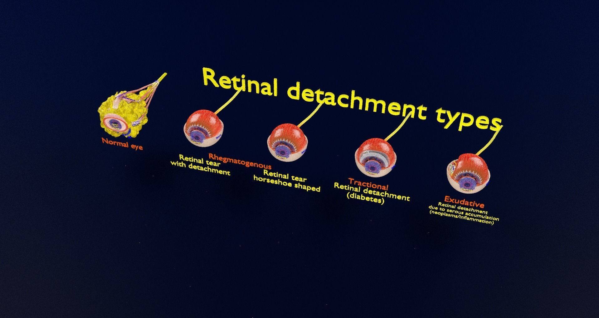 Retinal detachment types eye 3D model_95
